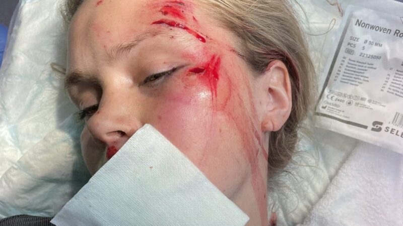 &laquo;Мало що&nbsp;пам'ятаю&raquo;: учасниця Олімпійських ігор у&nbsp;Пекіні потрапила у&nbsp;серйозну аварію на&nbsp;велосипеді